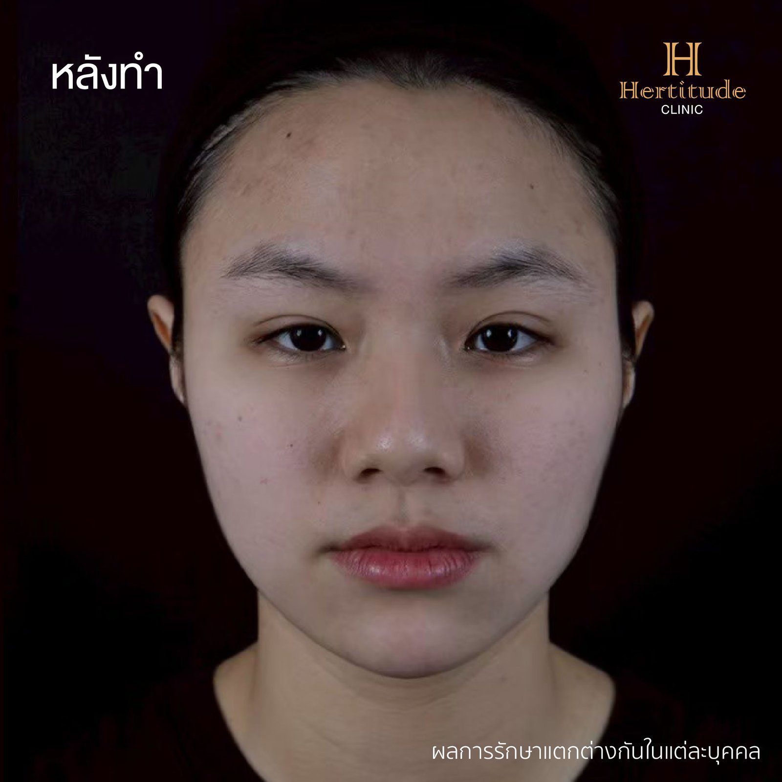 รีวิว k’first ก่อนทำ (1)