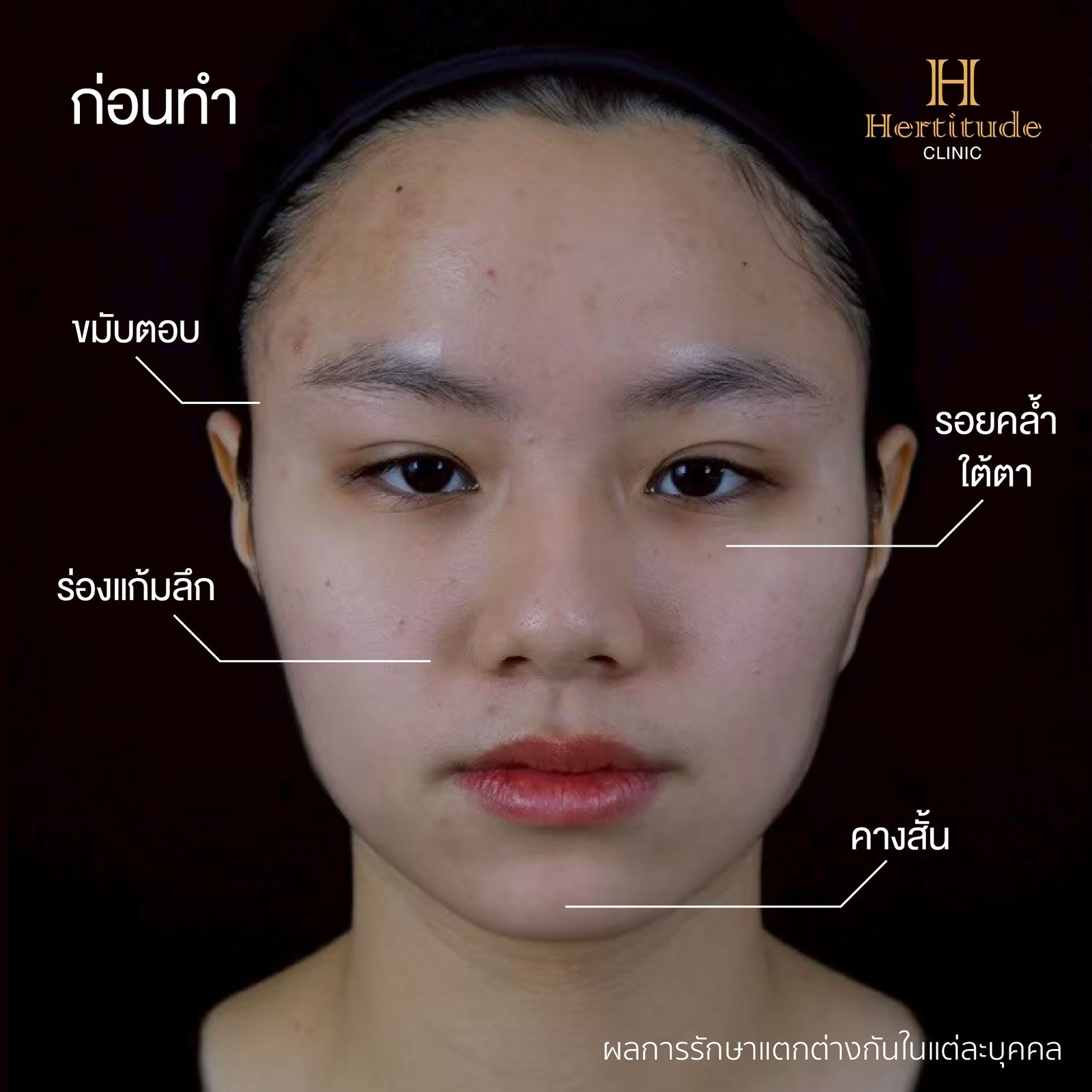 รีวิว k’first ก่อนทำ