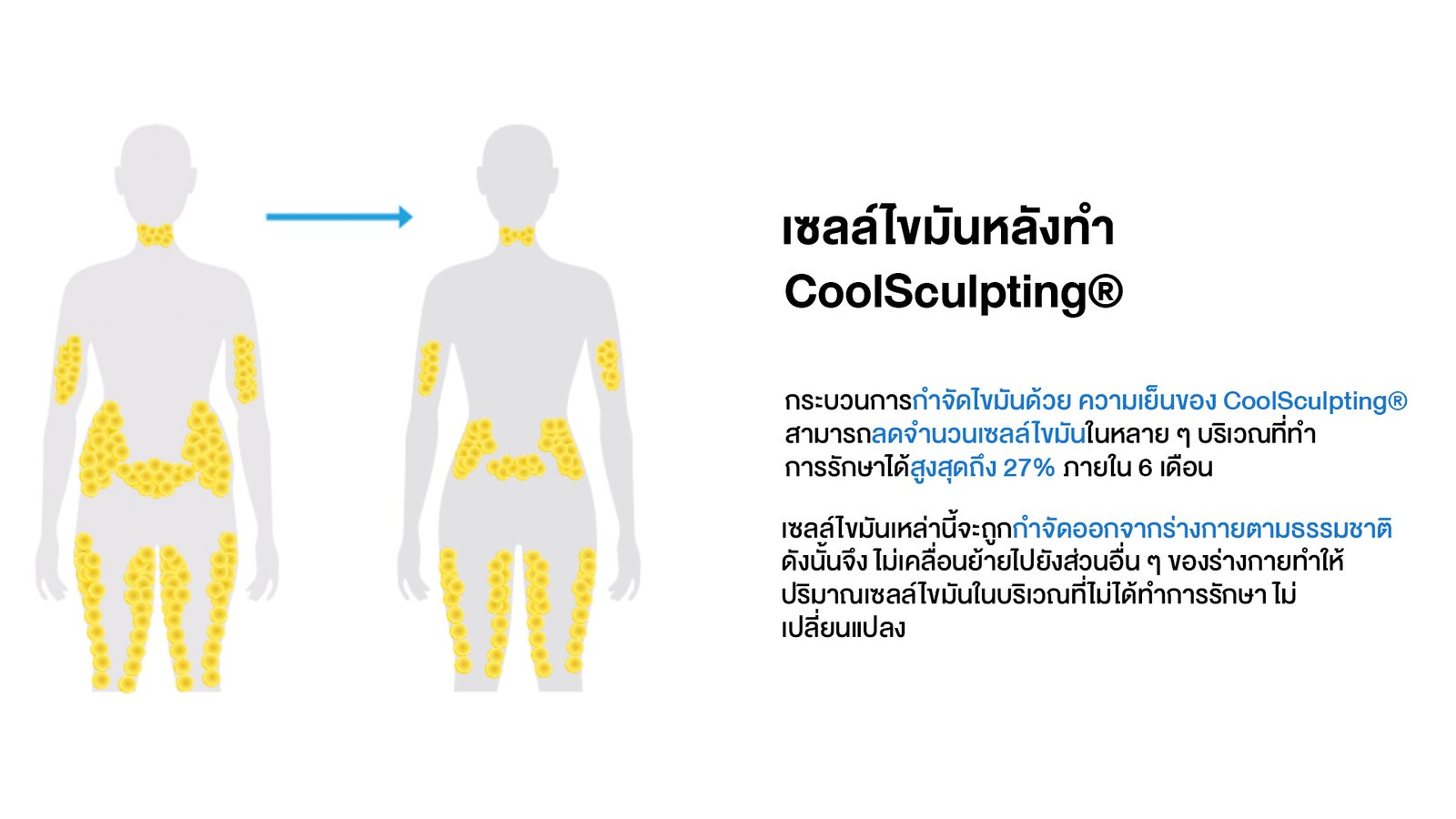 Coolsculpting_03